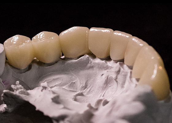 Bon prix Porcelaine fondue dans des couronnes métalliques: une technologie de pointe pour restaurer un sourire durable en ligne