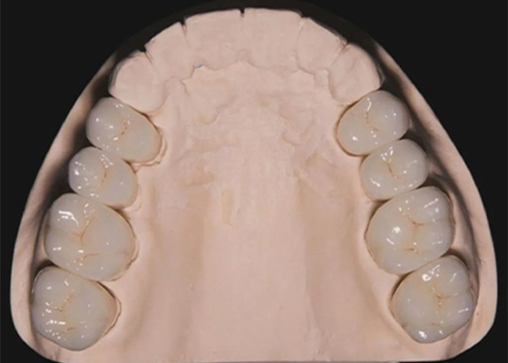 Bon prix Restauration dentaire Dents Circonia couronnes dentaires fabriquées par laboratoire dentaire en Chine en ligne