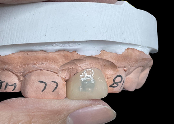 Bon prix Les facettes EMAX transforment votre sourire avec des dents naturelles très translucides en ligne