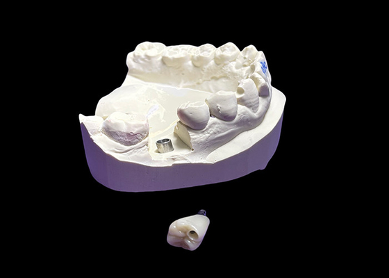 Bon prix Implant dentaire avec couronne en céramique et abutement en titane pour molaire en ligne