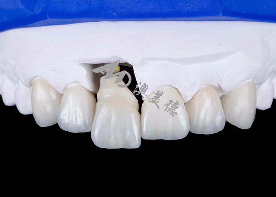 Bon prix Une couronne d'implant dentaire en titane pour un sourire naturel en ligne