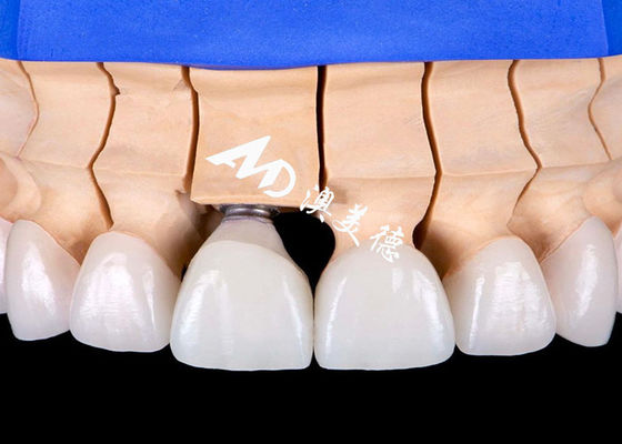Bon prix Implantation dentaire à base d'alliage de titane biocompatible pont couronne avec un aspect esthétique naturel en ligne