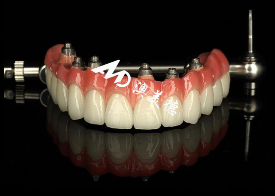 Bon prix Prothèses dentaires personnalisées à l'aide d'implants dentaires, pont de couronne pour l'entretien des dents manquantes en ligne