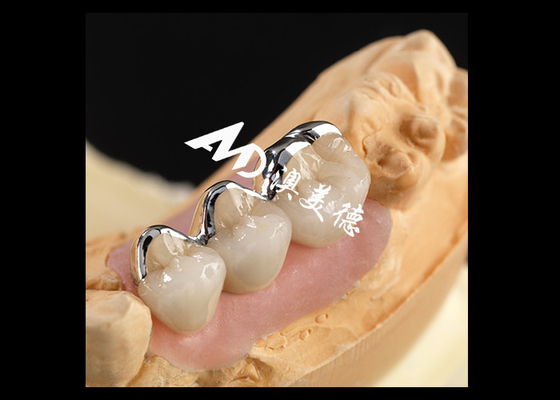 Bon prix Porcelaine PFM solide fusionnée à la couronne métallique Excellente biocompatibilité Résistance à l'usure en ligne