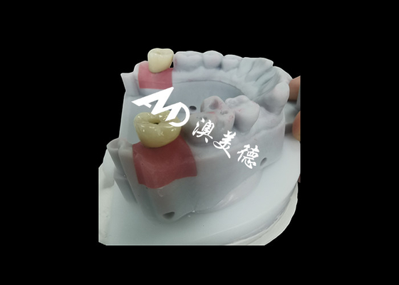Bon prix Couronne d'implant dentaire avec apotement en titane pour la restauration dentaire durable en ligne