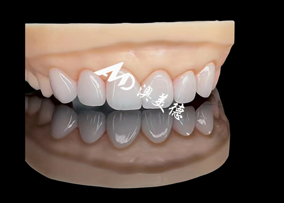 Bon prix Porcelaine EMAX Veneer Restaurations esthétiques de haute précision avec une durabilité supérieure en ligne