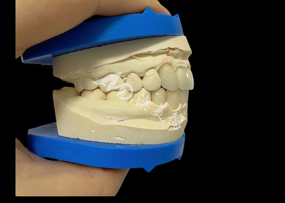 Bon prix Une couronne dentaire en zirconium pour un sourire naturel en ligne
