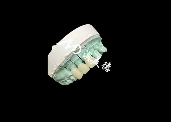 Bon prix Une couronne en céramique d'Emax est une solution personnalisable et abordable pour la restauration dentaire en ligne