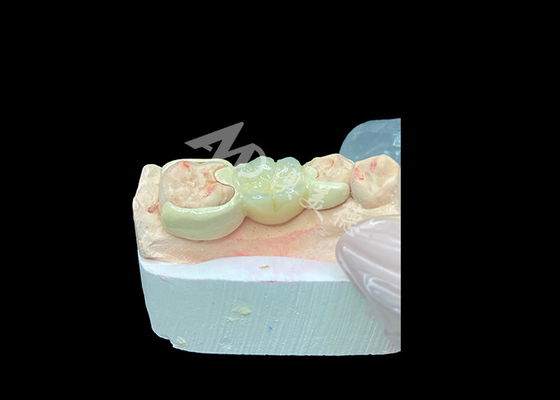 Bon prix Couronne en zirconium avec pont lié HPP pour améliorer l'esthétique du sourire et la biocompatibilité en ligne
