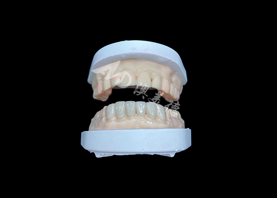 Bon prix IPS Emax Veneers Restaurations d'apparence naturelle pour des sourires esthétiques en ligne