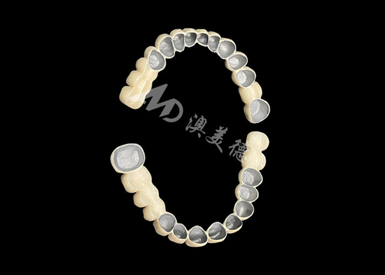 Bon prix Porcelaine personnalisée fusionnée à un pont de couronne dentaire métallique pour améliorer le sourire naturel en ligne