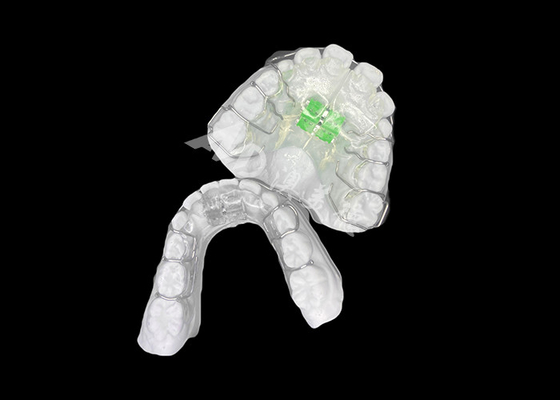 Bon prix Un expansateur orthodontique amovible efficace pour un alignement optimal de la mâchoire et une bonne santé dentaire en ligne