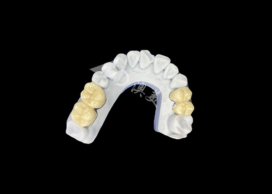 Bon prix Une couronne dentaire en porcelaine en zirconium PFZ provenant d'un laboratoire dentaire professionnel en Chine en ligne