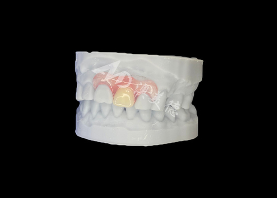 Bon prix Prothèse partielle souple sur mesure pour un confort naturel et durable en ligne
