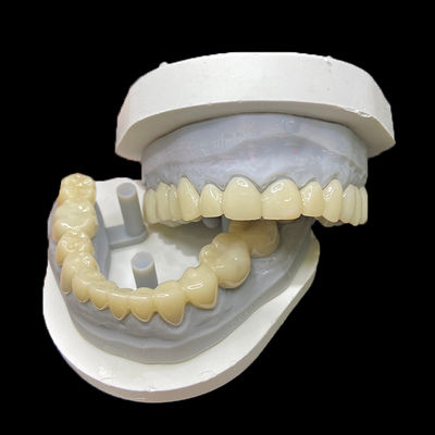 Bon prix Restaurations provisoires en PMMA CAD/CAM : couronnes et bridges en PMMA pour cas dentaires provisoires en ligne