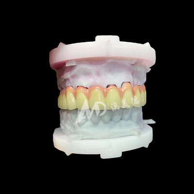 Bon prix Couronne et bridge en céramique de titane pur : restaurations esthétiques, durables et légères en ligne