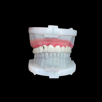 Bon prix Pont d'implant de pleine voûte avec cadre métallique CoCr haute résistance et revêtement en porcelaine haut de gamme pour un ajustement précis en ligne